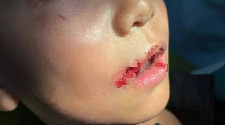  广州滑板场地事故频发隐患；男孩重伤后家长维权，协议效力备受争议。 新闻